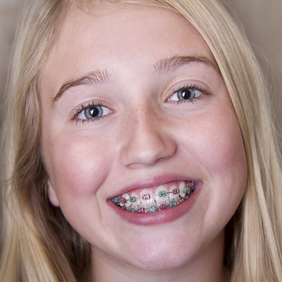 Some kids can't wait to get their braces, seeing them as a sign th...